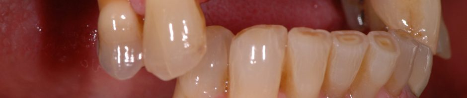 Photo showing how losing a tooth can affect face shape over time