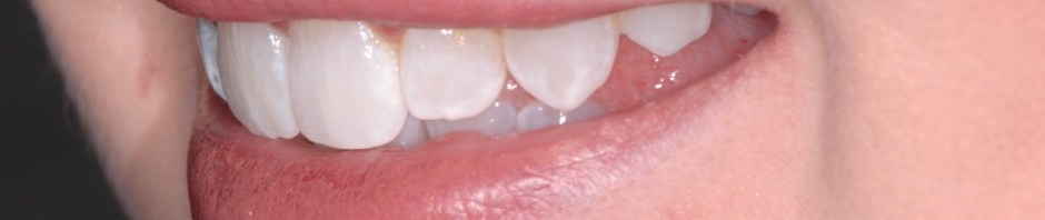 After Invisalign treatment showing straight, aligned teeth and confident smile at Christchurch Dental Practice